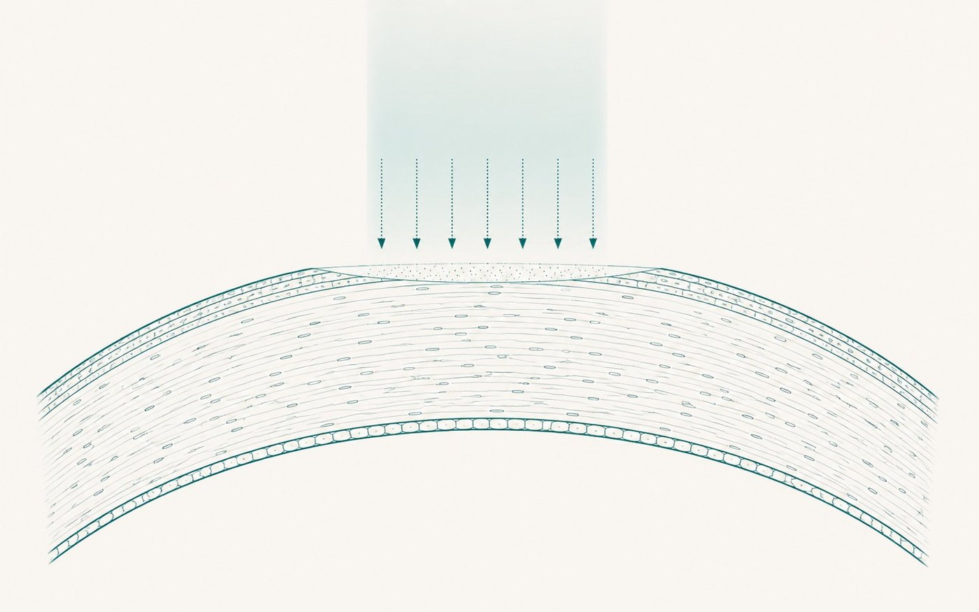 Schematische Darstellung der PRK/transPRK: das Epithel ist zentral entfernt, der Laser modelliert die Hornhautoberfläche.